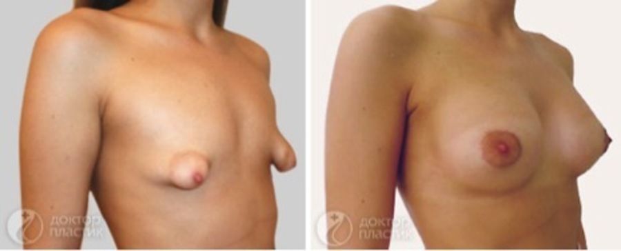 Тубулярная грудь пластика фото до после
