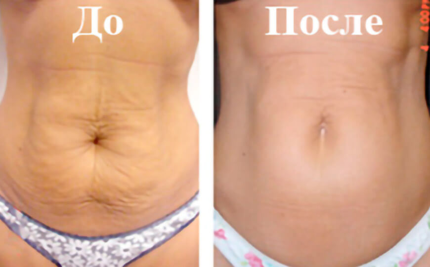 Фото до&nbsp;после тредлифтинга