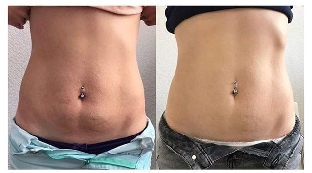 Тредлифтинг фото до&nbsp;после коррекции живота