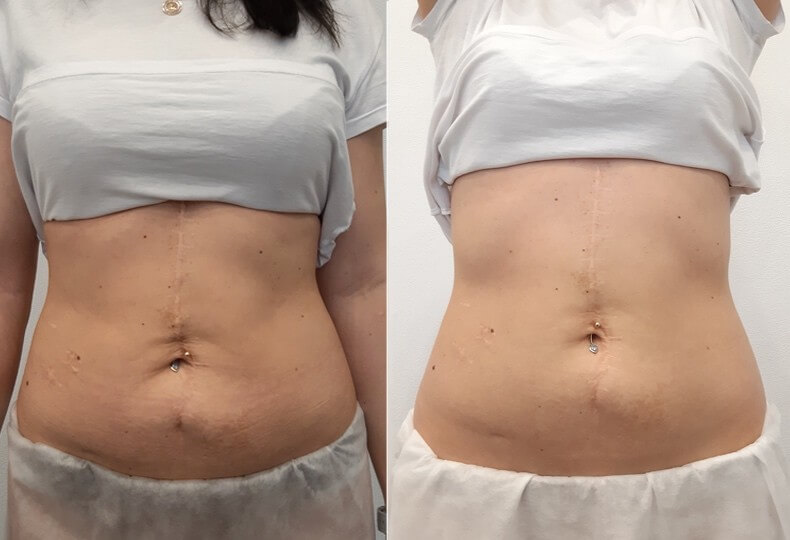 Фото до&nbsp;после подтяжки живота после родов&nbsp;&mdash; тредлифтинг