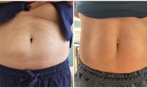 Красивый живот, или&nbsp;как&nbsp;работает EmSculpt фото до&nbsp;после