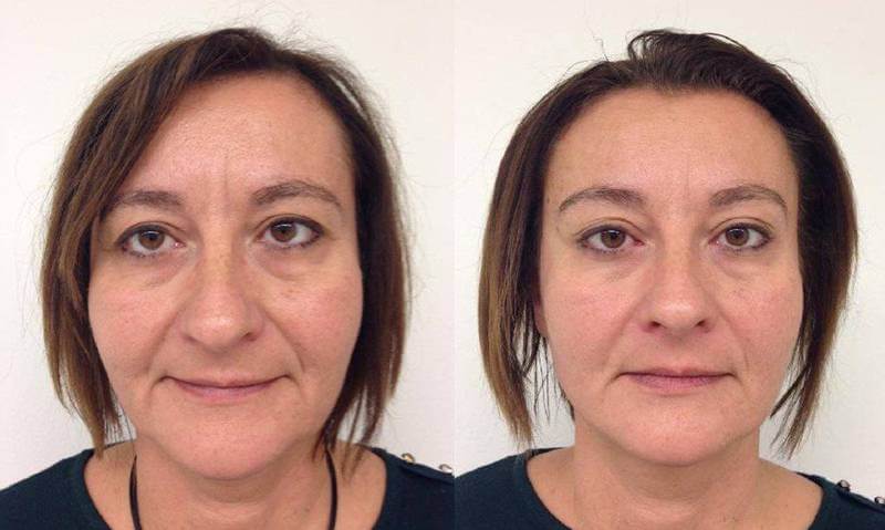 Фото до&nbsp;после фронтлифтинга &ndash; удаление морщин