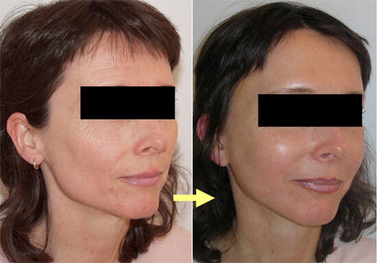 Фронтлифтинг фото до&nbsp;после подтяжки лба