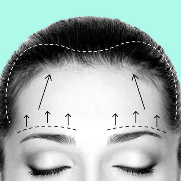 Схема подтяжки лба&nbsp;&mdash; фронтлифтинг