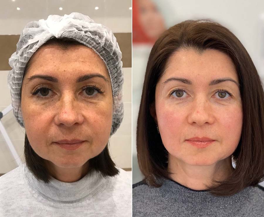 Фото до после тюнинга лица