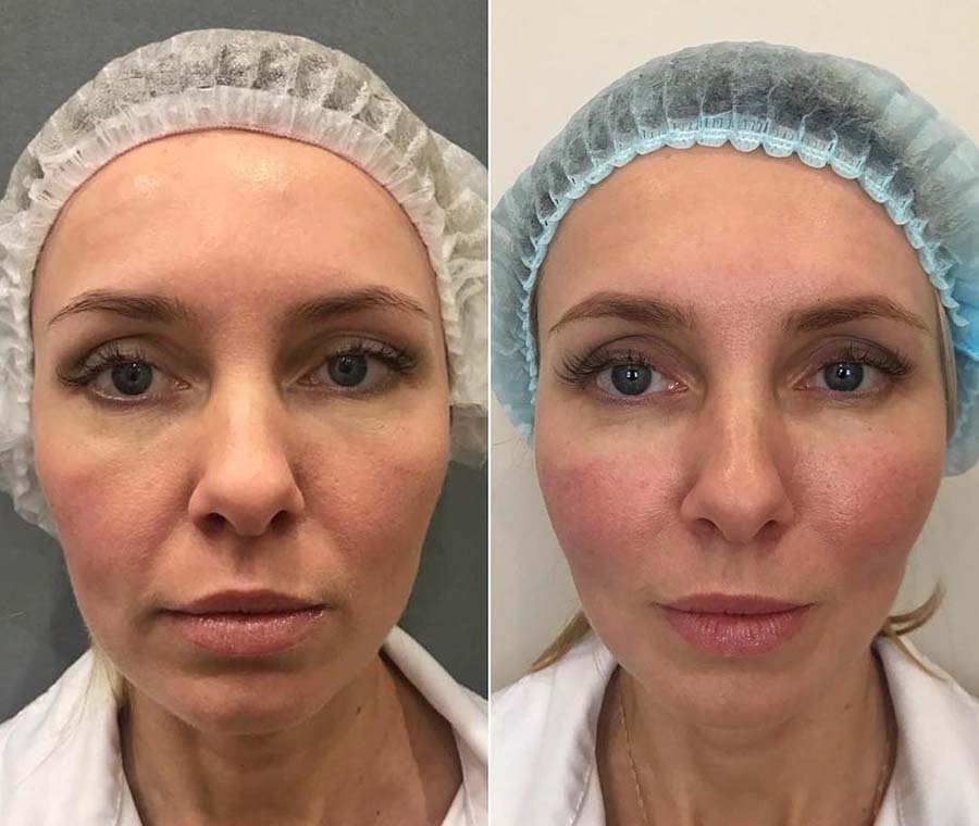 Тюнинг лица фото до и после