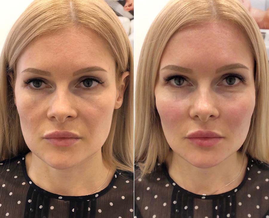 Тюнинг лица: фото до после