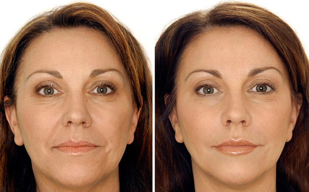 Фото до после тюнинга лица