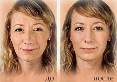 Фото до после тюнинга лица