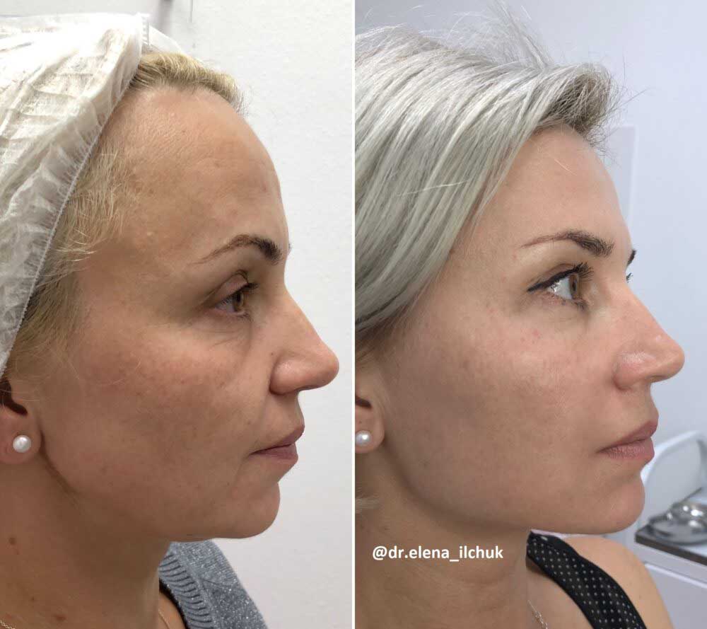 Фото до после тюнинга лица