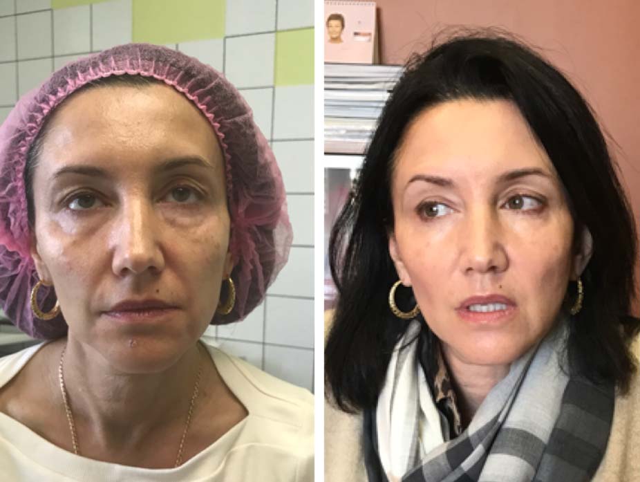 Тюнинг лица: фото до после