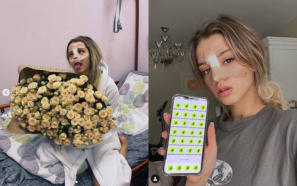 Юлия Гаврилина ринопластика