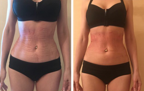 Фото до&nbsp;после коррекции талии