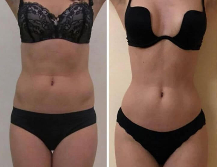 Фото до&nbsp;после липосакции талии