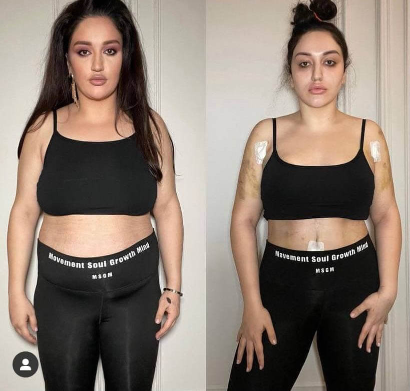 Гоар Аветисян до&nbsp;и&nbsp;после