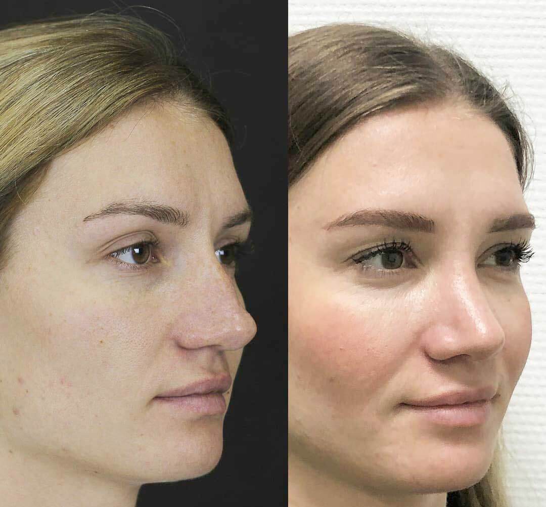 Повторная ринопластика фото до после