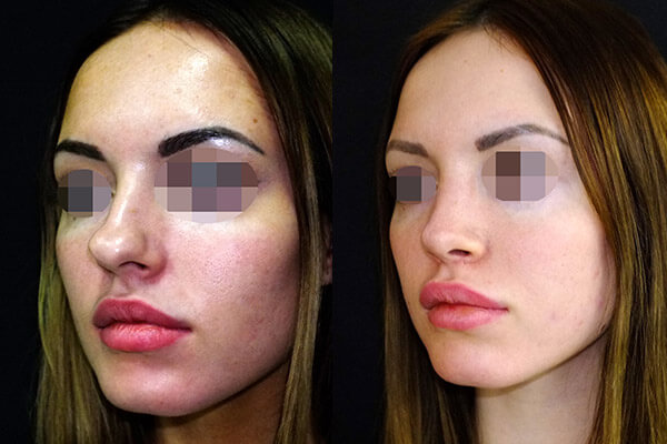 Повторная ринопластика фото до после 2 операции