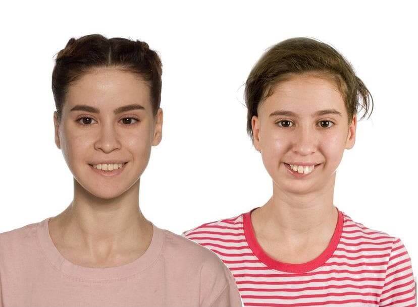 Хахадетка до&nbsp;операции