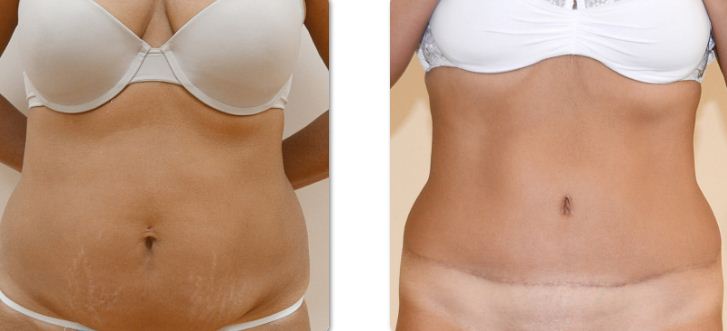 Фото до после пластики живота