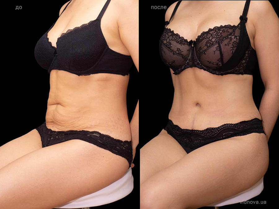 Фото до после абдоминопластики