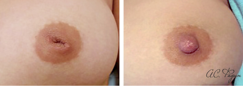 Фото до&nbsp;после коррекции сосков