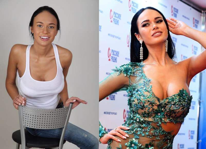 Фото до&nbsp;после пластики груди Яны Кошкиной