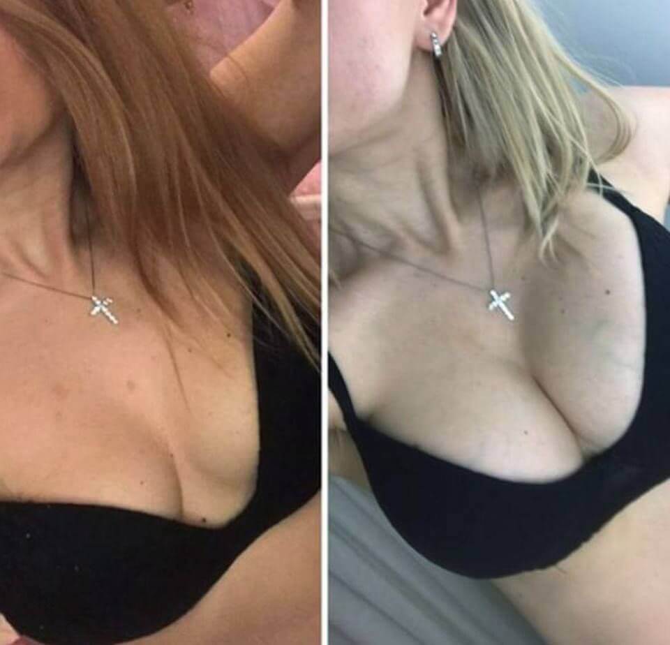 Фото до&nbsp;после увеличения груди