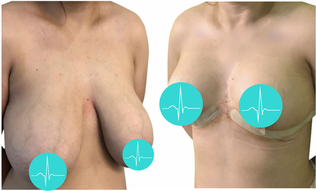 Подтяжка груди &ndash; до&nbsp;и&nbsp;после фото