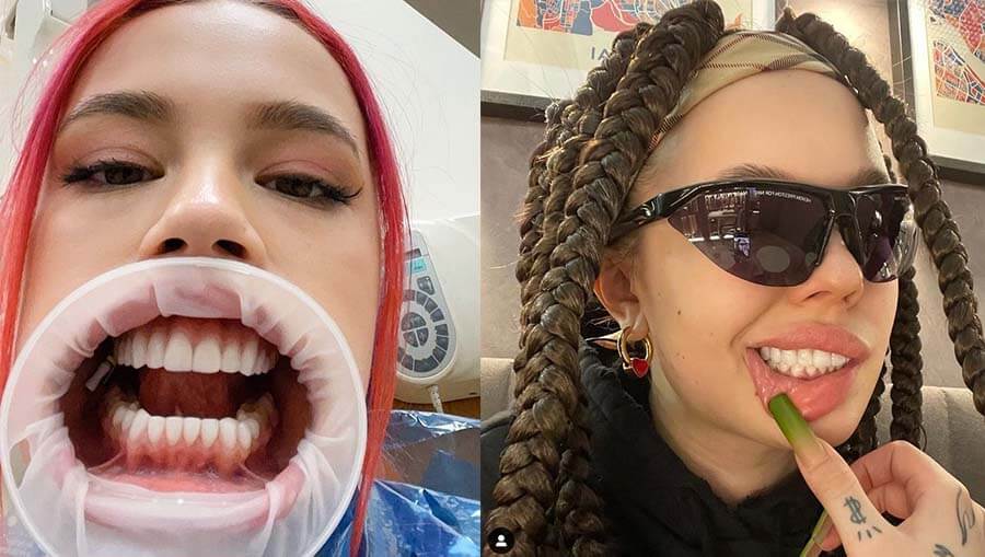 Инстасамка виниры