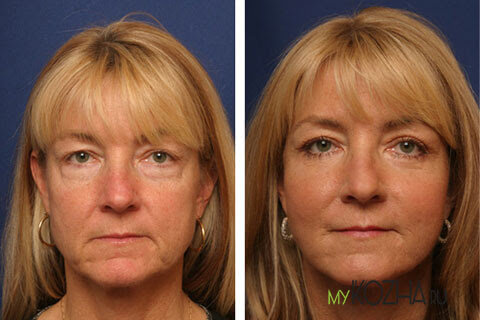 Фото до и после удаления морщин марионетки