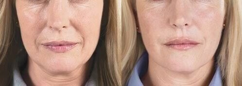 Фото до и после устранения морщин с помощью мезо-коктейлей