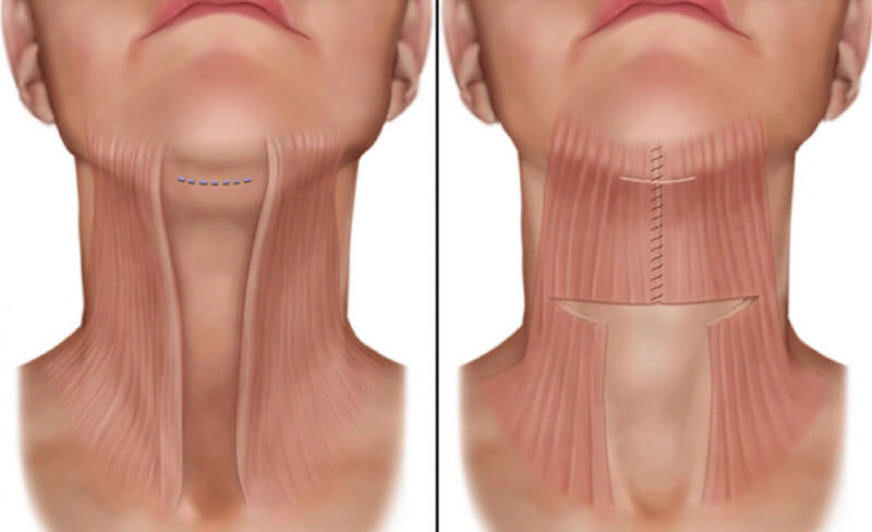 Платизма – мышца шеи и принцип ее подшива – платизмопластика