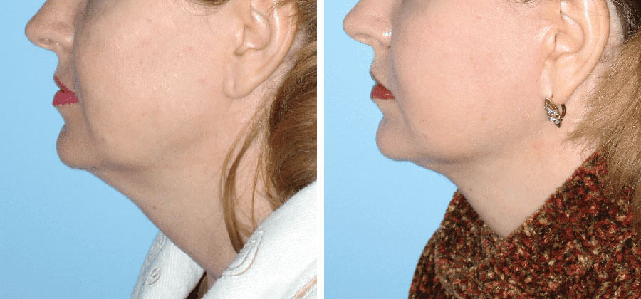 Фото до после подтяжки шеи