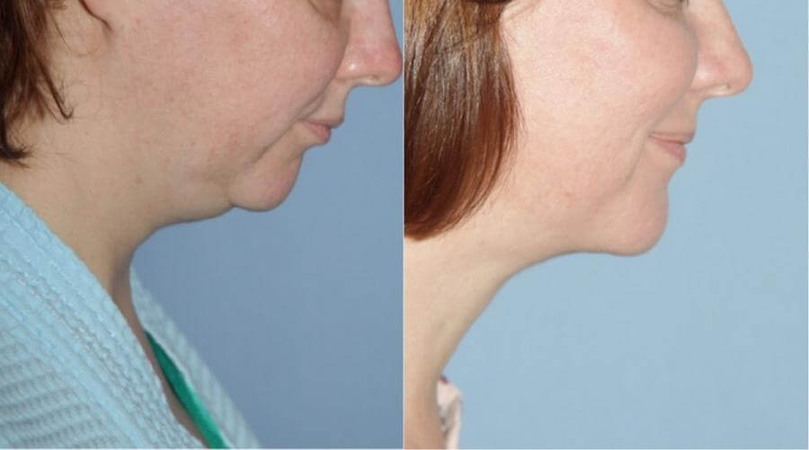 Коррекция второго подбородка фото до после