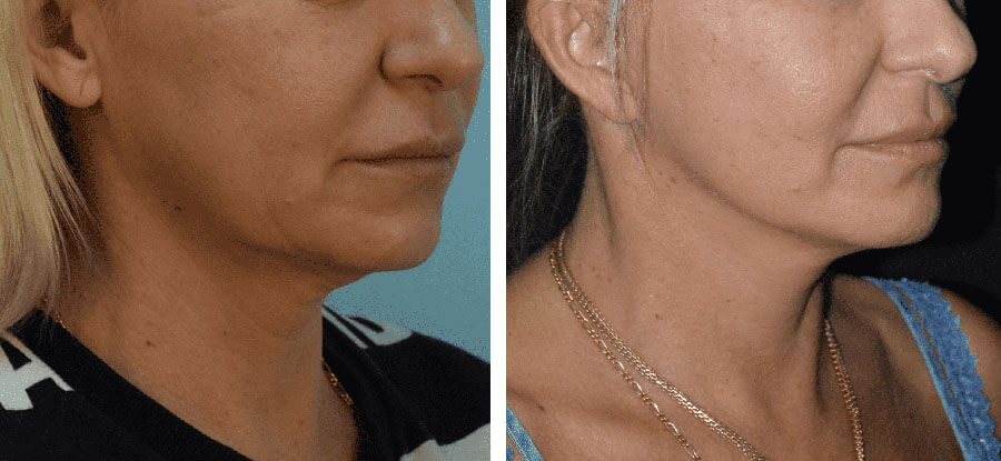 Фото до после подтяжки шеи и устранения морщин