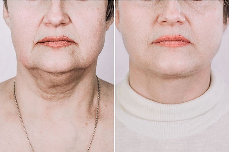 Подтяжка шеи фото до после процедуры