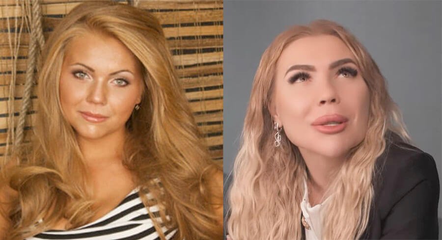 Карина Кросс пластика губ