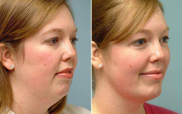 Фото до&nbsp;после пластики шеи