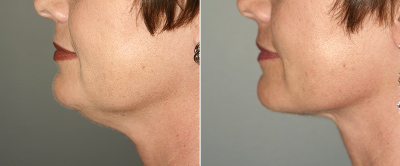 Фото до&nbsp;после подтяжки шеи