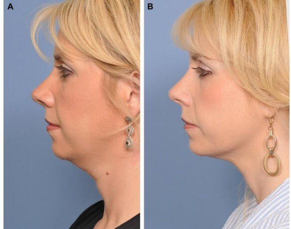 Фото до&nbsp;после лифтинга шеи