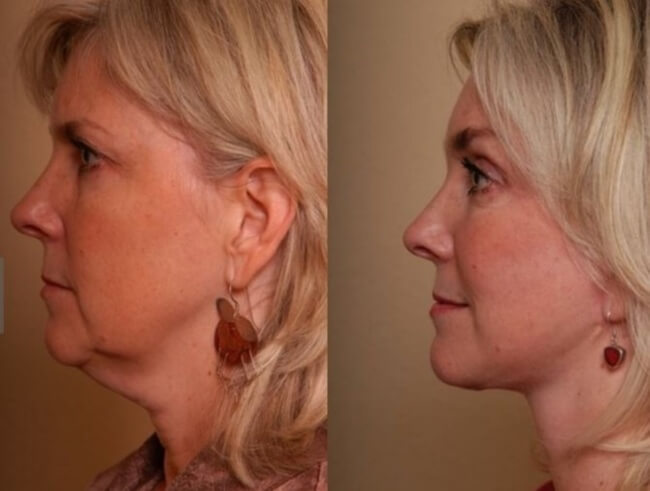 Фото до&nbsp;после подтяжки шеи