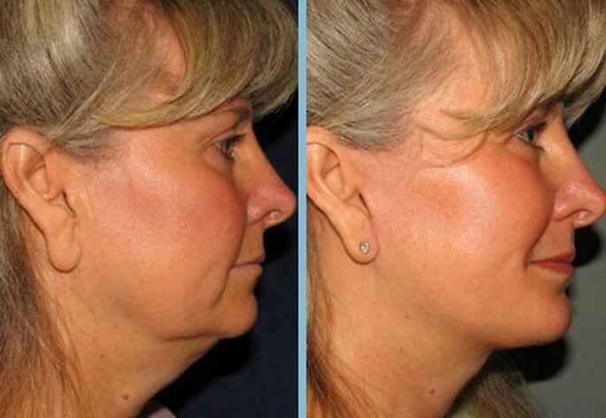 Подтяжка шеи фото до&nbsp;после