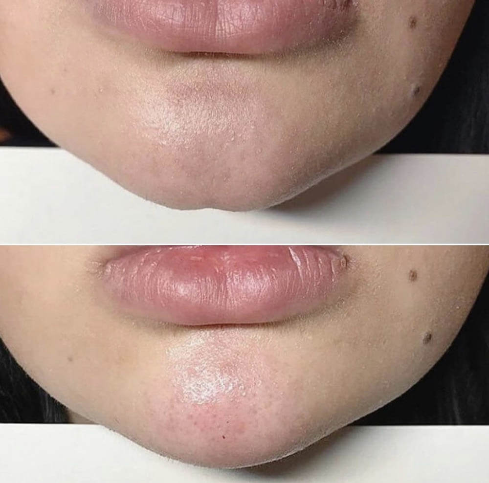 Фото до&nbsp;после коррекции подбородка филлерами