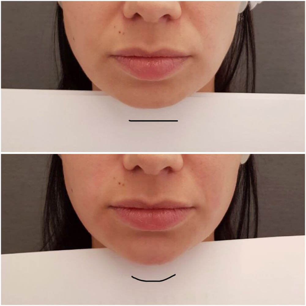 Фото до&nbsp;после коррекции подбородка