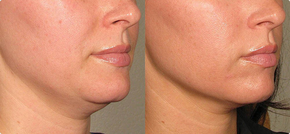 Фото до&nbsp;после пластики подбородка филлерами