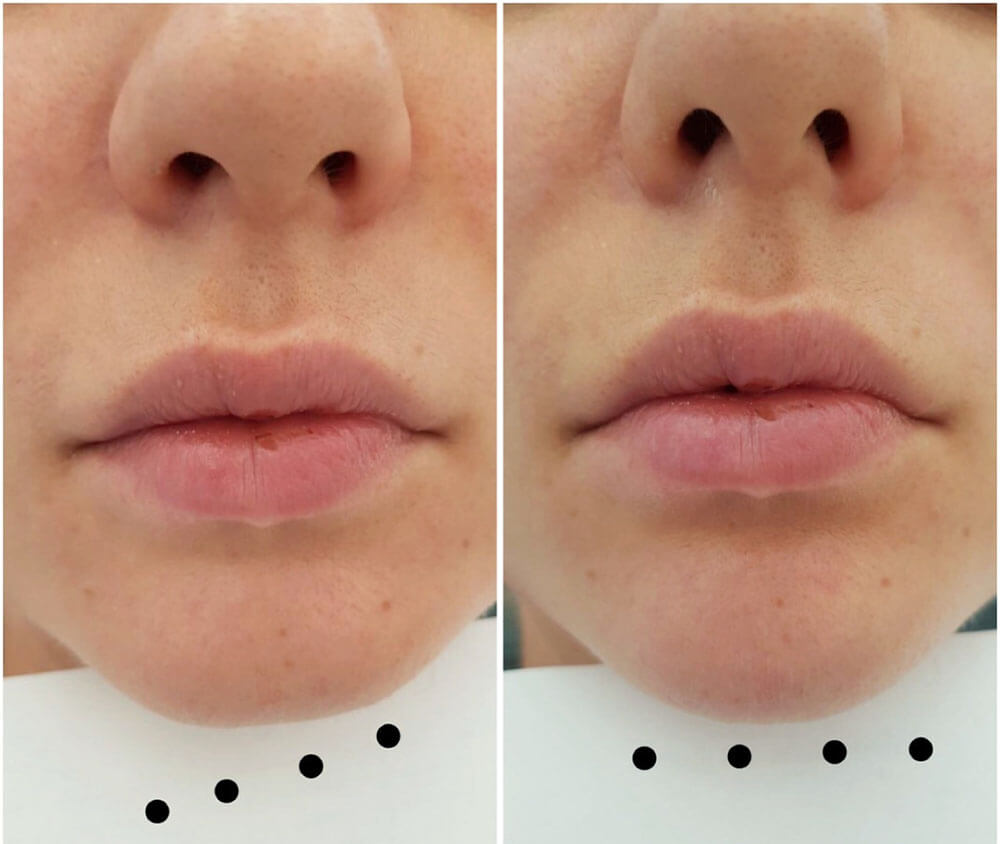 Коррекция подбородка филлерами фото до&nbsp;после