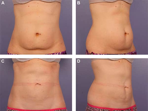 Фото до после криолиполиза