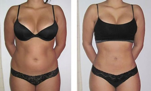 Фото до после криолиполиза талии и живота