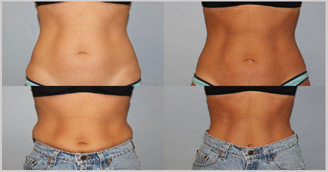 Эффект криолиполиза: фото до после