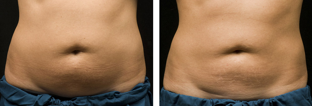 Фото до после криолиполиза области живота